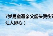 7岁男童遭亲父烟头烫伤双手面临截肢什么情况（男童现况让人揪心）